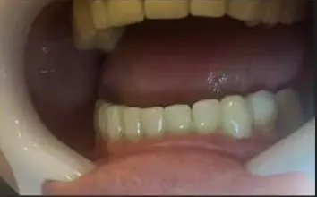 Después - coronas inferiores