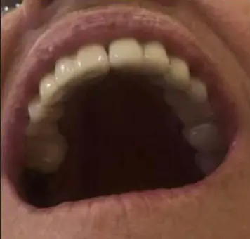 Después - diseño en zirconio